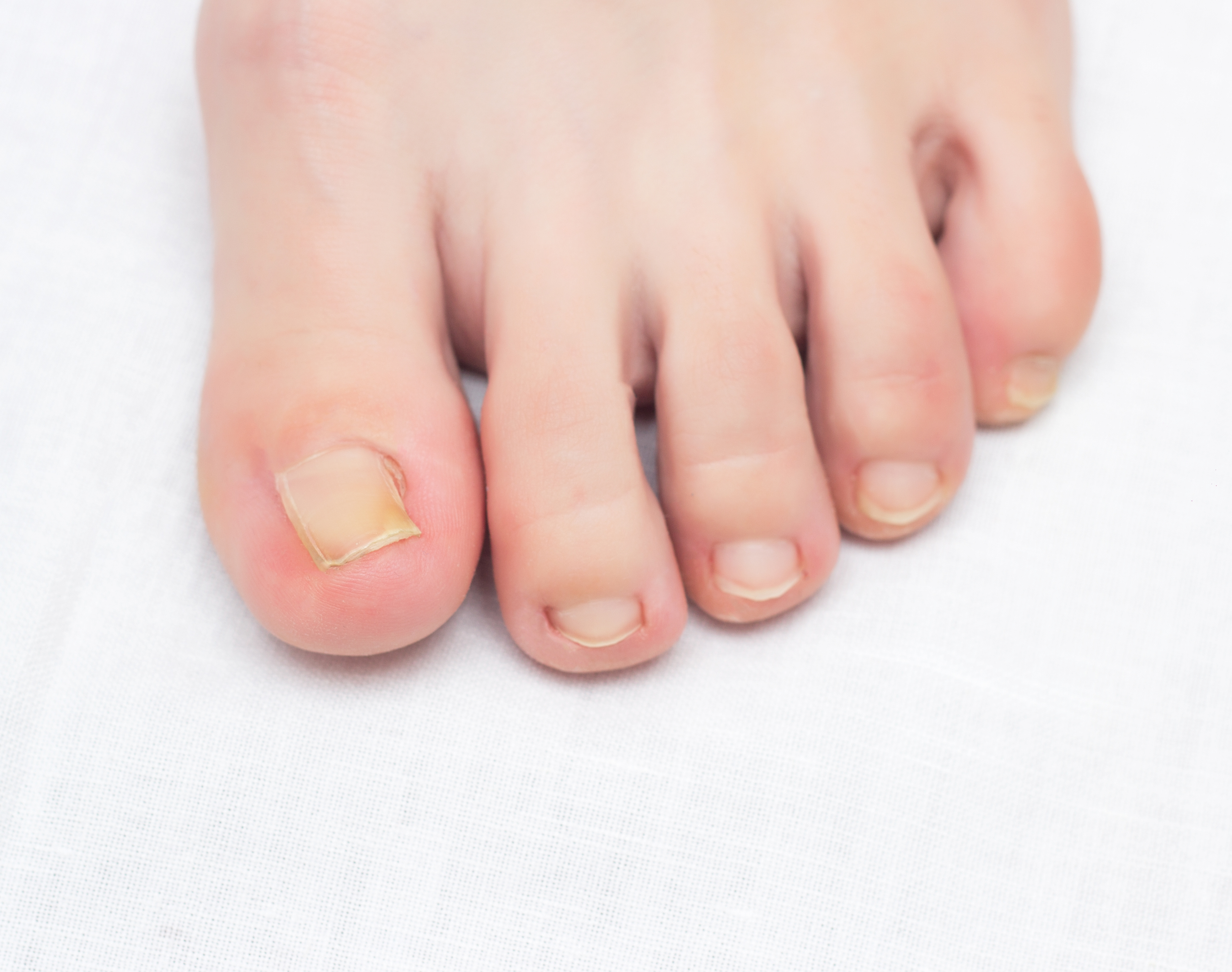 Ingrown Toenails: Causes, Treatment, & Prevention