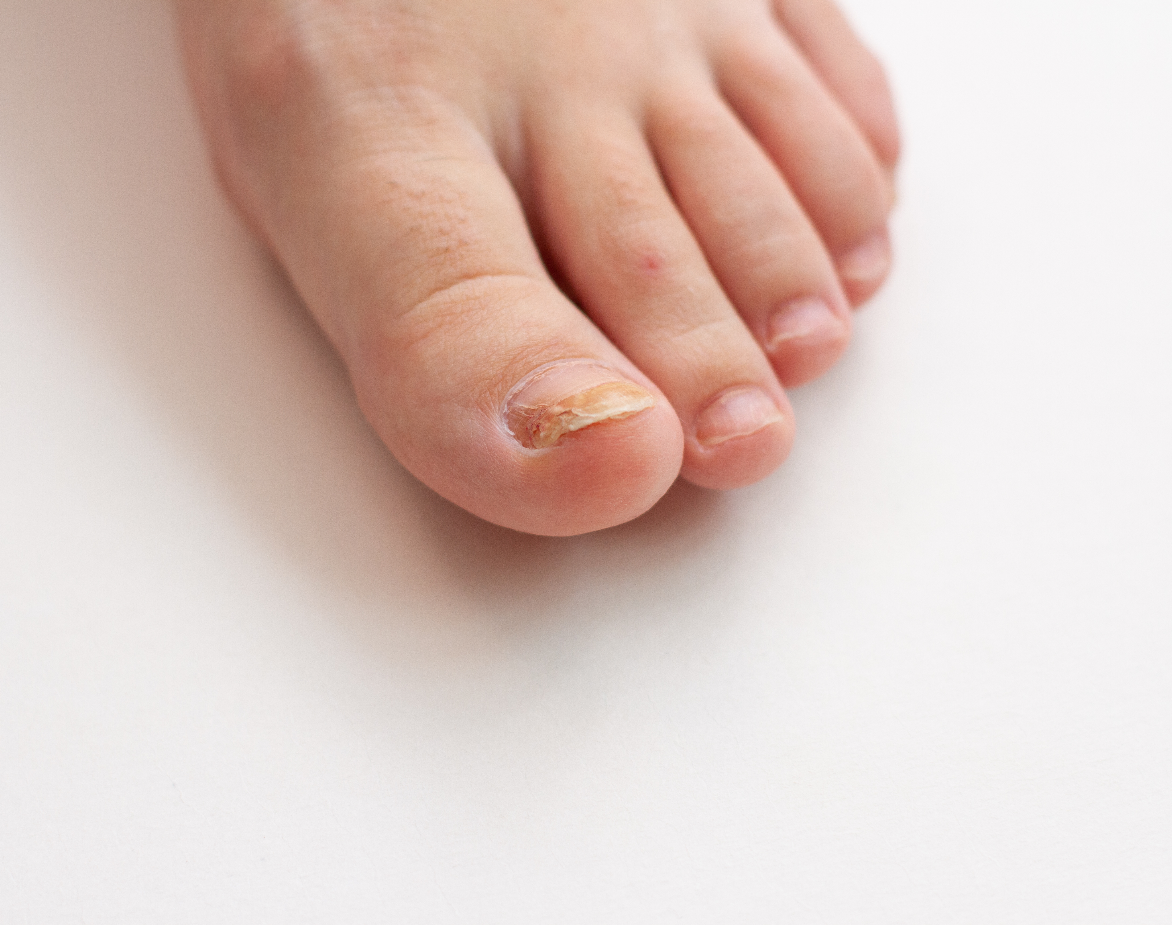My Nails Have Fungus. Should I Still Get My Nails Done?