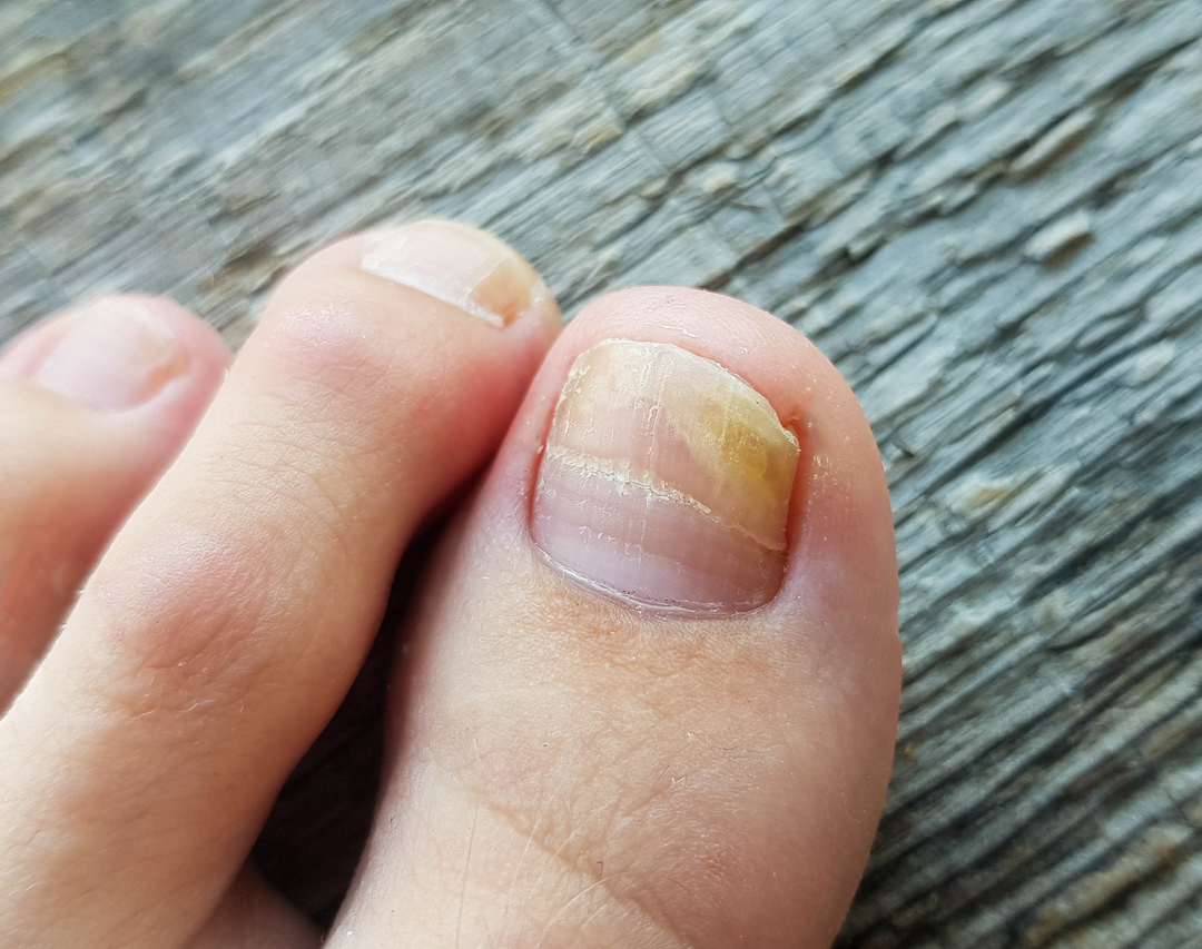 Nail Abnormalities - Part 2 (Koilonychia, Clubbing & Onycholysis)